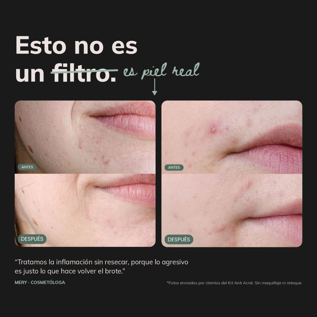 Kit dúo Anti-acné™ | Triácidos + Serum reparador