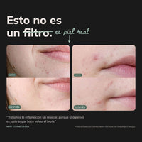 Kit dúo Anti-acné™ | Triácidos + Serum reparador