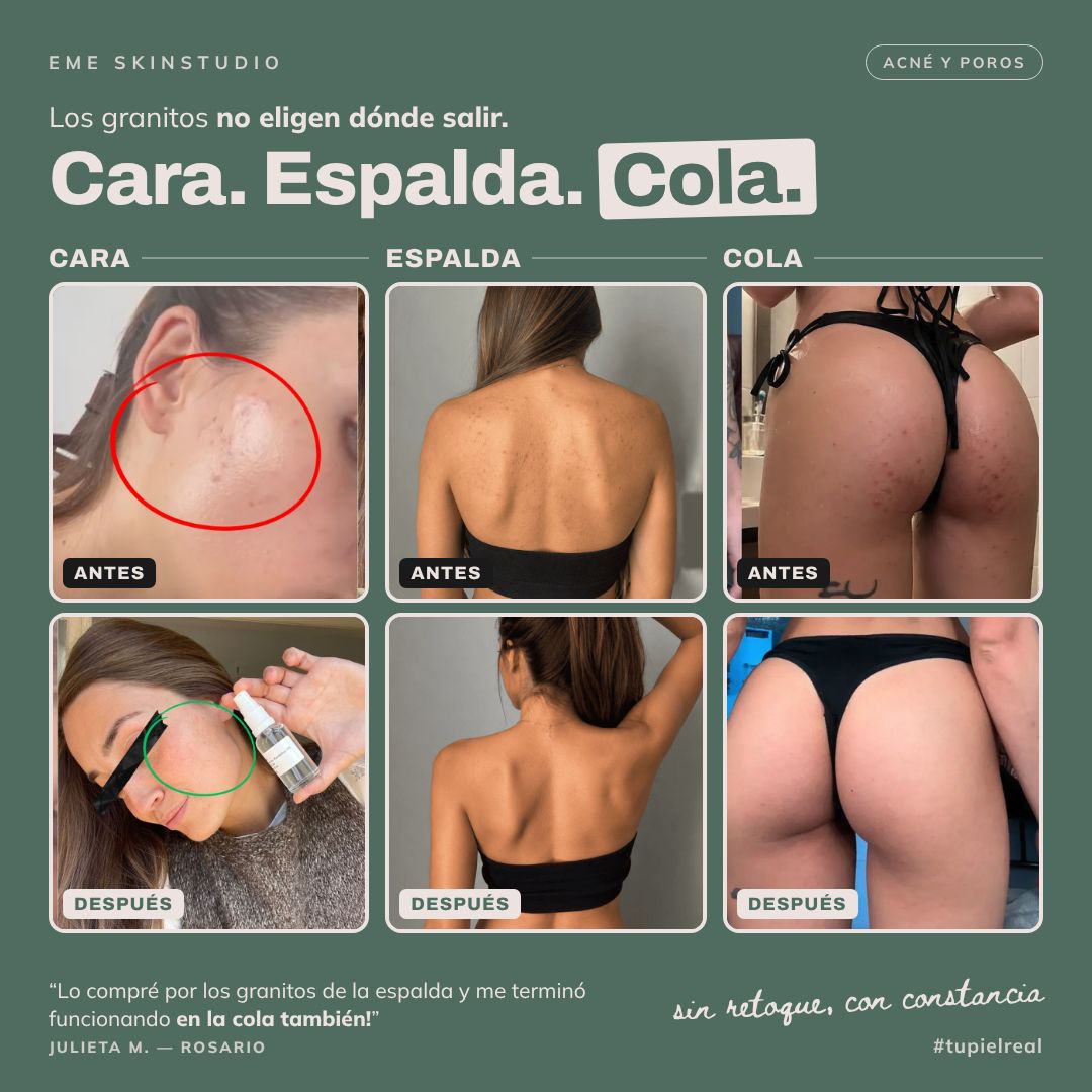 Kit dúo Anti-acné™ | Triácidos + Serum reparador